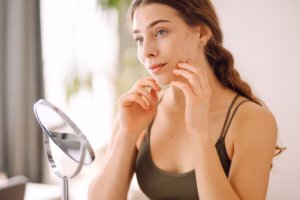 Woman examining acne, pores, and scars in a handheld mirror, reflecting concerns about natural skin and the need for acne treatment