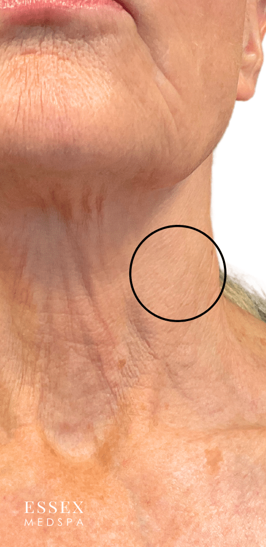 After Image: Fractional CO2 with PRP for Nodule - front