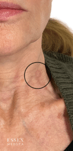 Before Image: Fractional CO2 with PRP for Nodule