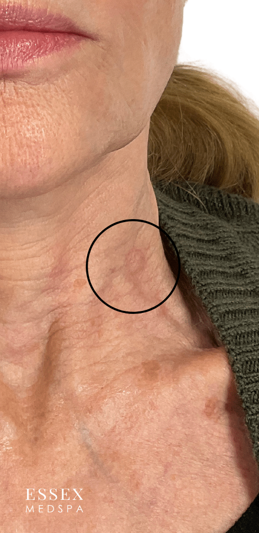 Before Image: Fractional CO2 with PRP for Nodule - front