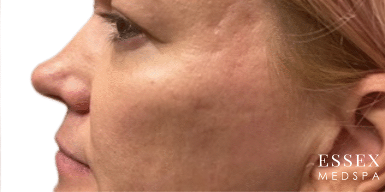 After Image: Facial Volume and Contour - left-side