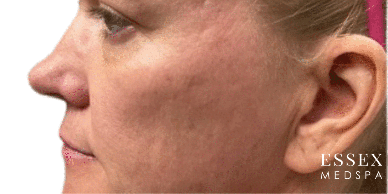 Before Image: Facial Volume and Contour - left-side