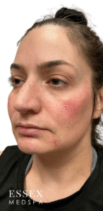 After Image: Cheek Filler