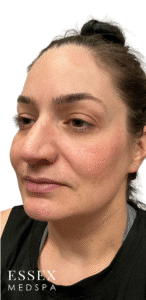 Before Image: Cheek Filler