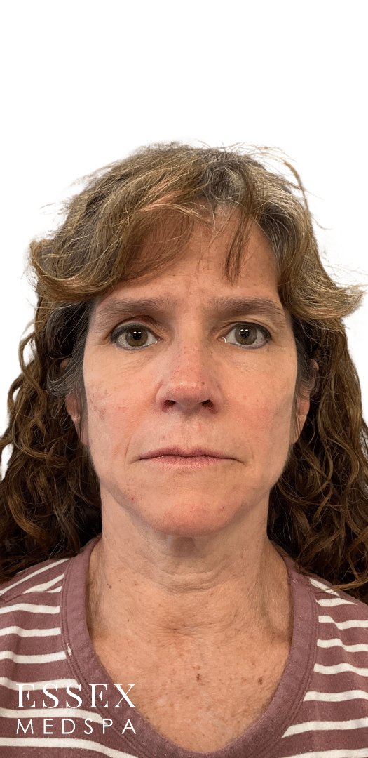 After Image: Dermal Fillers for Marionette and Chin - front