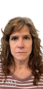 Before Image: Dermal Fillers for Marionette and Chin