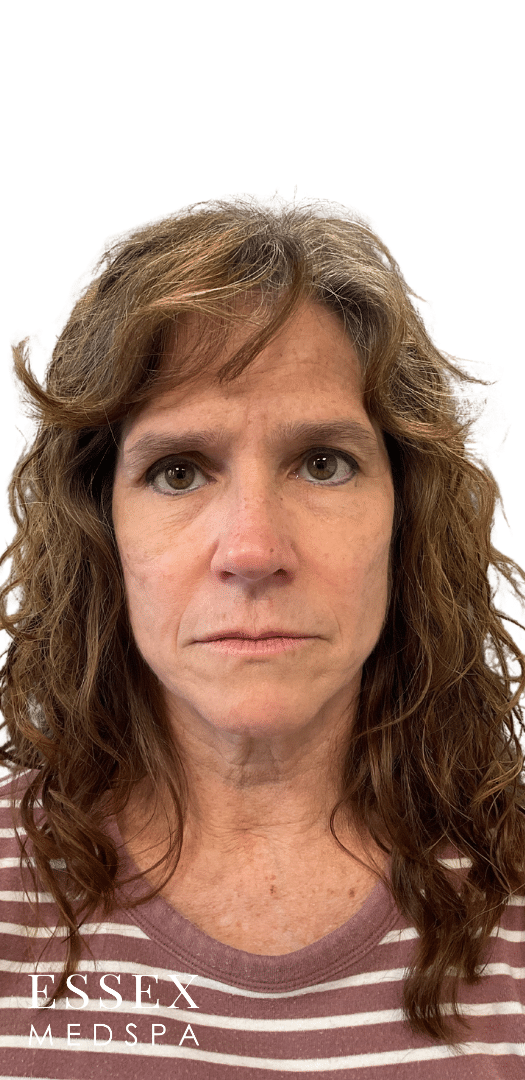 Before Image: Dermal Fillers for Marionette and Chin - front