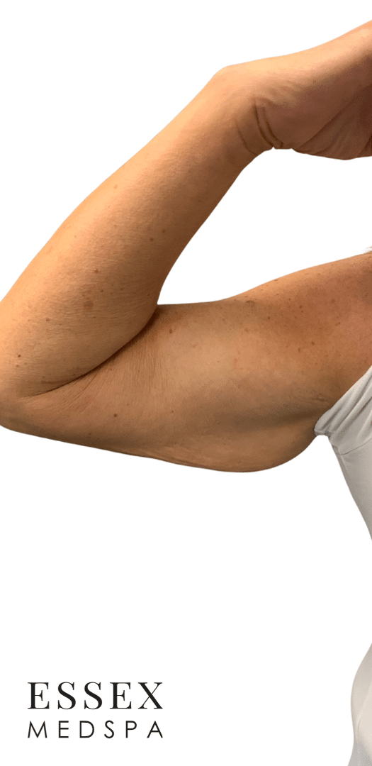 After Image: EvolveX Arms - front