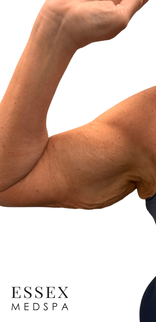 Before Image: EvolveX Arms - front
