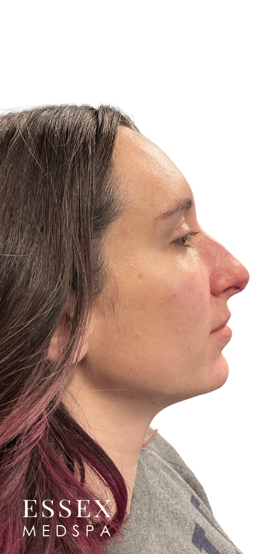 After Image: Dermal Filler for Facial Balancing - right-side