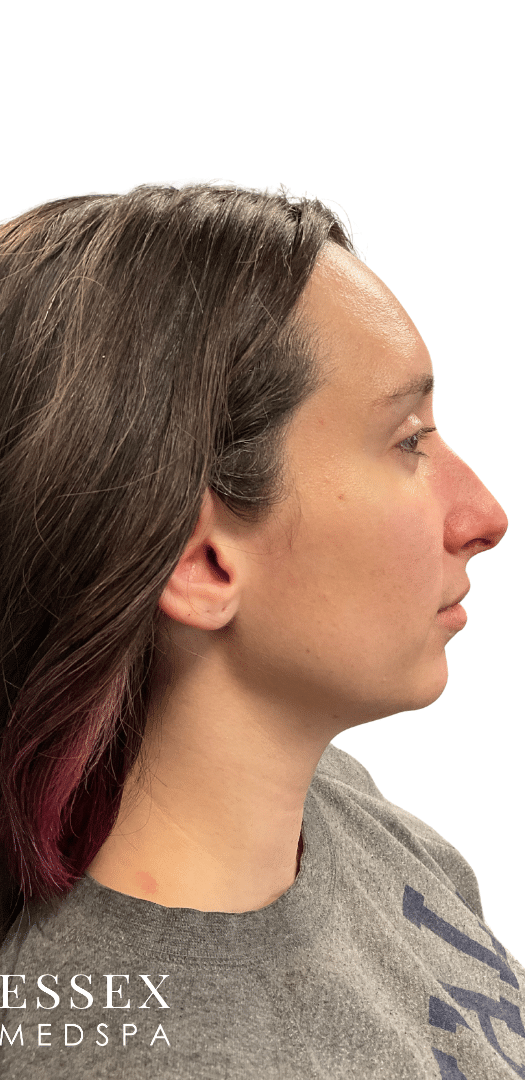 Before Image: Dermal Filler for Facial Balancing - right-side