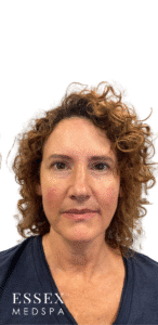 After Image: Cheeks and Lower Face Filler