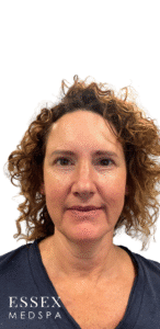 Before Image: Cheeks and Lower Face Filler