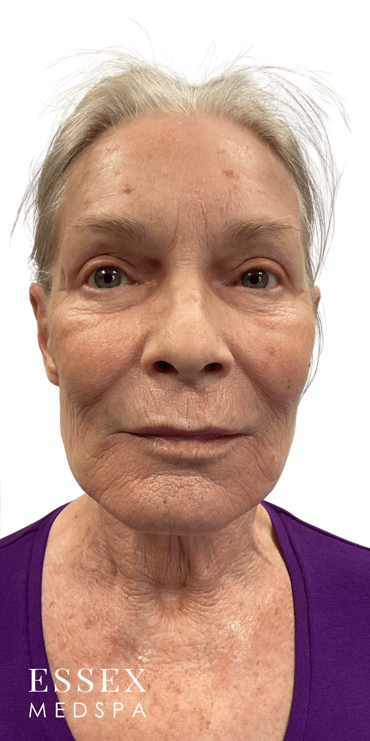 After Image: Fillers and Fractional CO2 - front