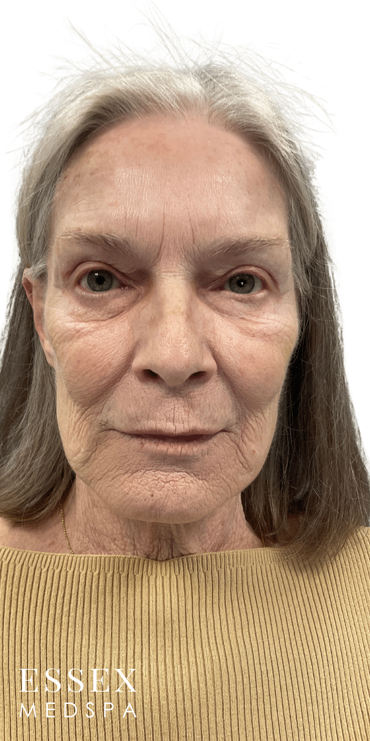 Before Image: Fillers and Fractional CO2 - front