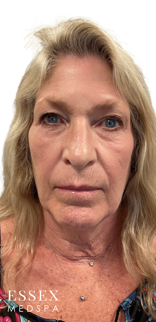 After Image: Fractional CO2 - front