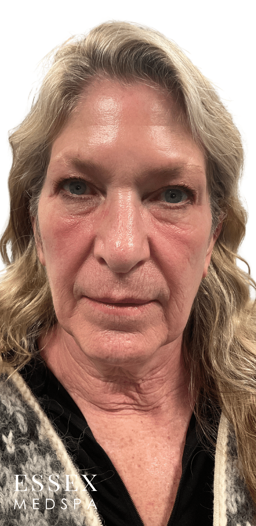 Before Image: Fractional CO2 - front