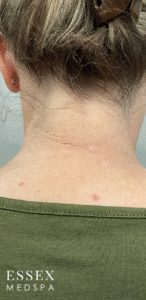 After Image: Fractional CO2 with PRP for Scar Reduction