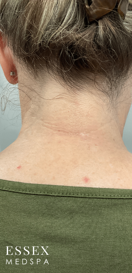 After Image: Fractional CO2 with PRP for Scar Reduction - back
