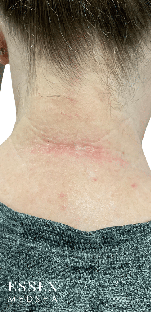 Before Image: Fractional CO2 with PRP for Scar Reduction - back