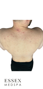 After Image: Fractional CO2