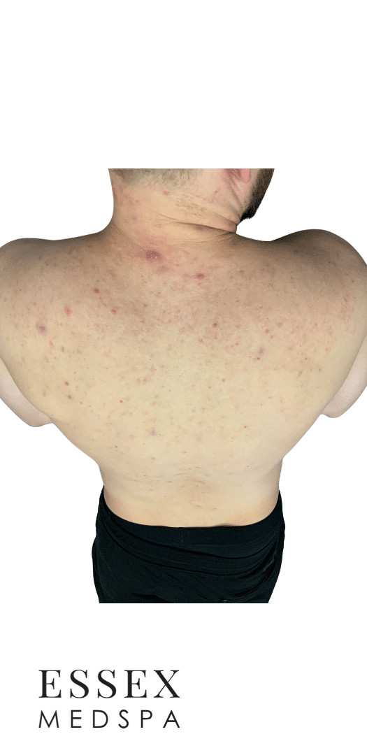 After Image: Fractional CO2 - back