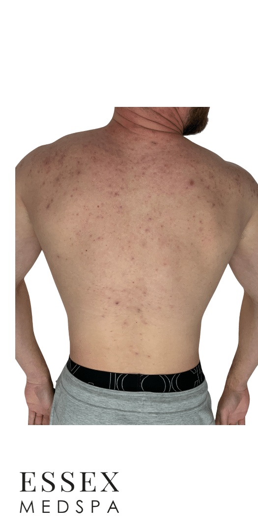 Before Image: Fractional CO2 - back