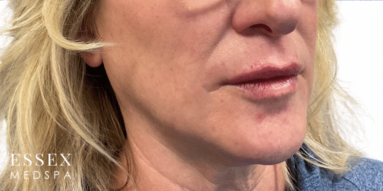 After Image: Lip Filler - right-front-oblique