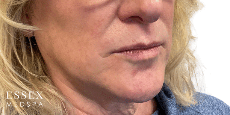 Before Image: Lip Filler - right-front-oblique