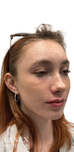 After Image: Lip Filler