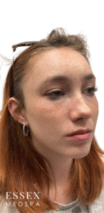 Before Image: Lip Filler