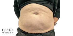 After Image: Morpheus8 Abdomen