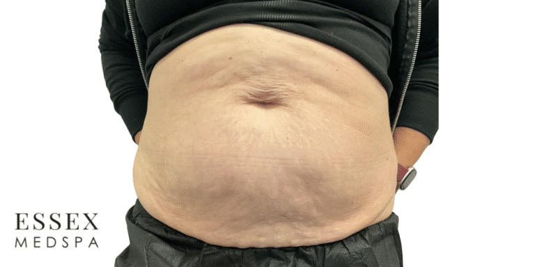 After Image: Morpheus8 Abdomen - front