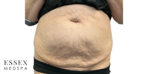 Before Image: Morpheus8 Abdomen