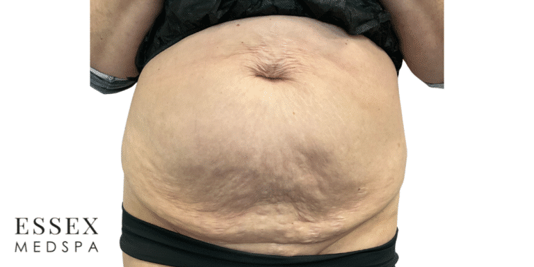 Before Image: Morpheus8 Abdomen - front