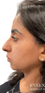 After Image: Morpheus8 with PRP for Scar Reduction