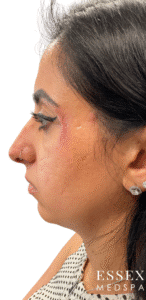 Before Image: Morpheus8 with PRP for Scar Reduction