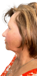 After Image: Morpheus8 for Marionette and Acne Scarring, and Skin Texture