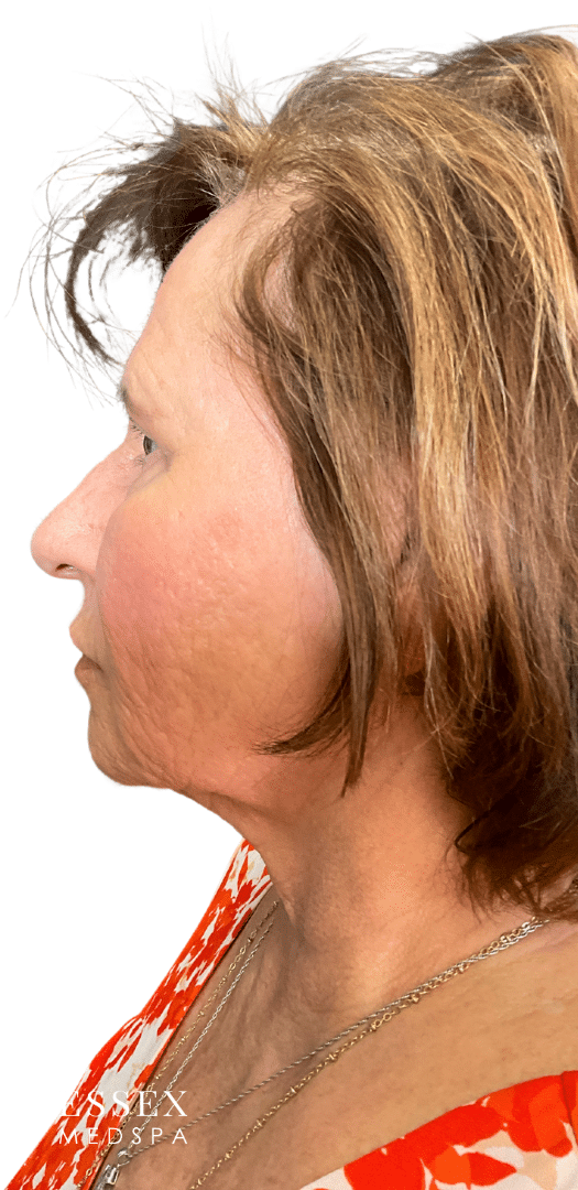 After Image: Morpheus8 for Marionette and Acne Scarring, and Skin Texture - left-side