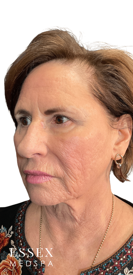 After Image: Morpheus8 for Marionette and Acne Scarring, and Skin Texture - left-front-oblique
