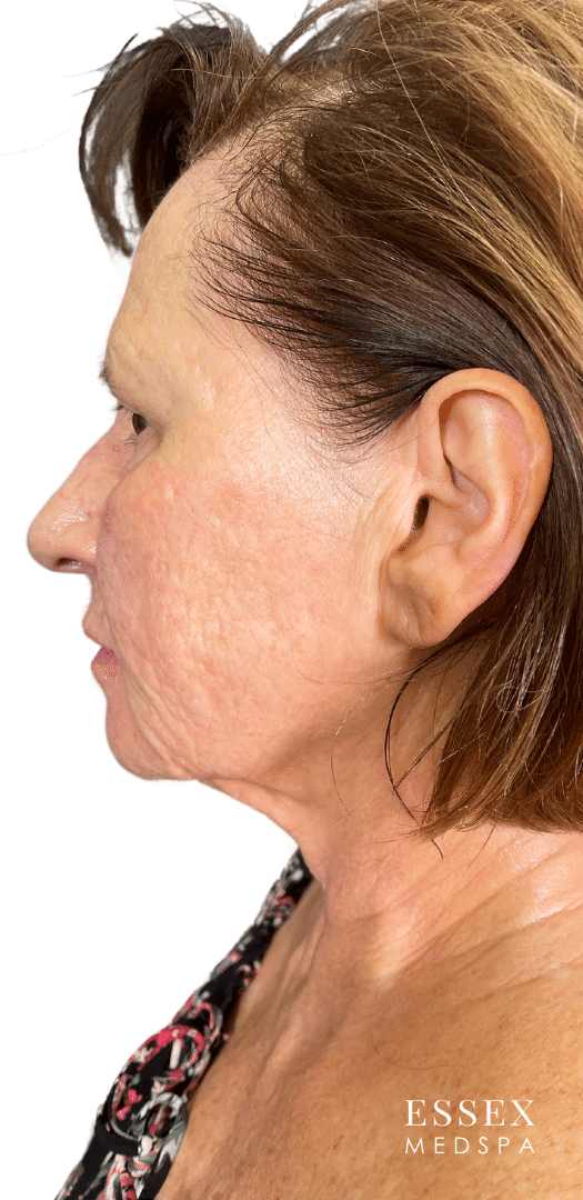 Before Image: Morpheus8 for Marionette and Acne Scarring, and Skin Texture - left-side