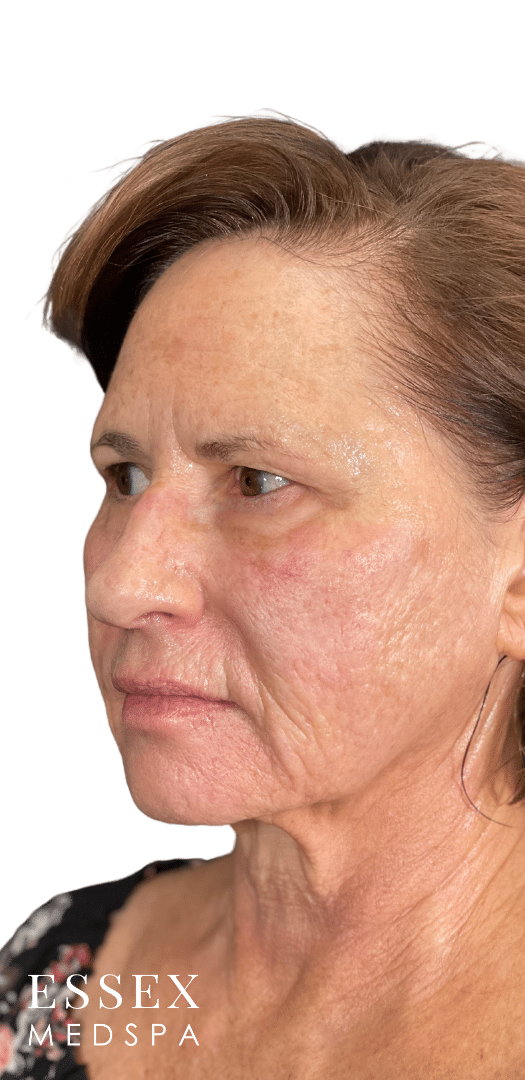 Before Image: Morpheus8 for Marionette and Acne Scarring, and Skin Texture - left-front-oblique