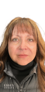 After Image: Morpheus8 for Under Eyes