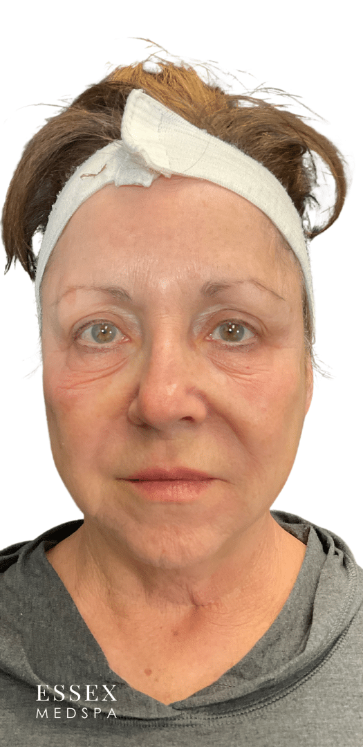 Before Image: Morpheus8 for Under Eyes - front