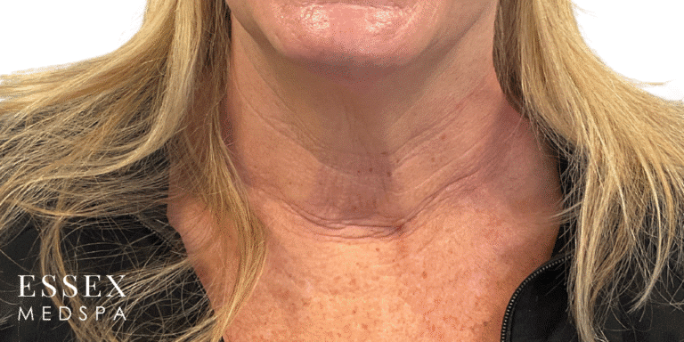 After Image: Toxin for Nefertiti Neck Lift and Crepiness - front