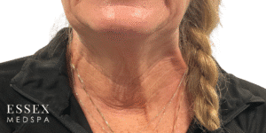 Before Image: Toxin for Nefertiti Neck Lift and Crepiness