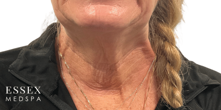 Before Image: Toxin for Nefertiti Neck Lift and Crepiness - front