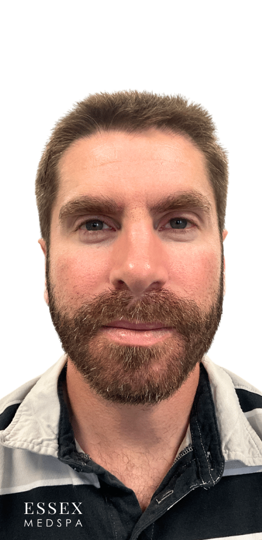 After Image: Neurotoxin – Forehead - front