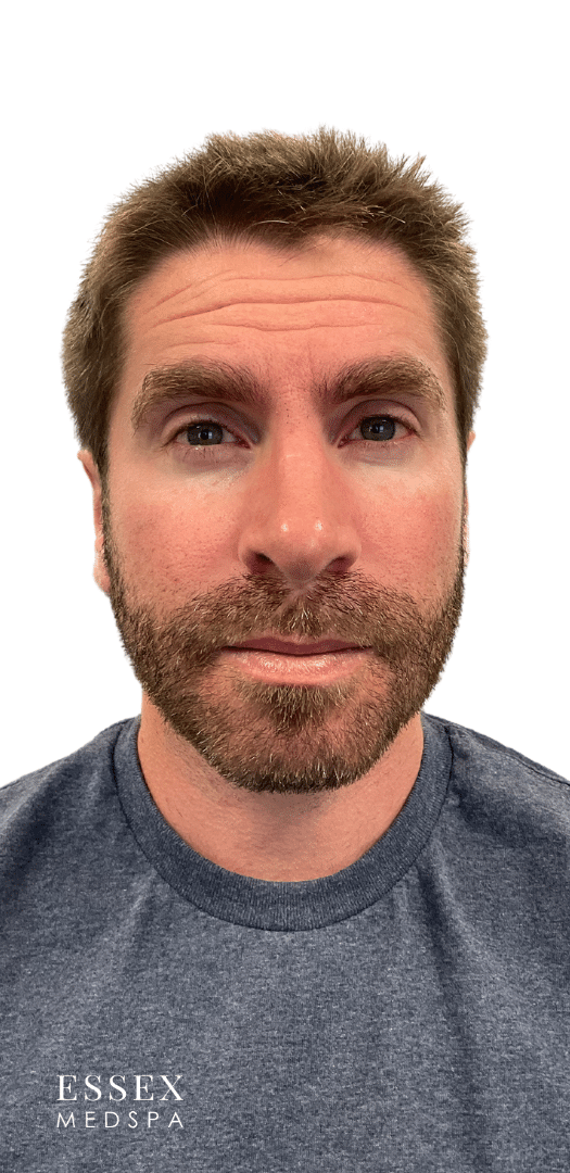 Before Image: Neurotoxin – Forehead - front