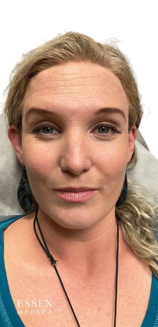 After Image: Toxin for Facial Lines - front